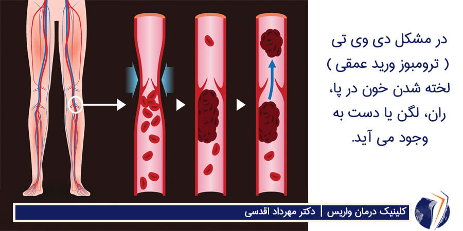 دی وی تی ( ترومبوز ورید عمقی )