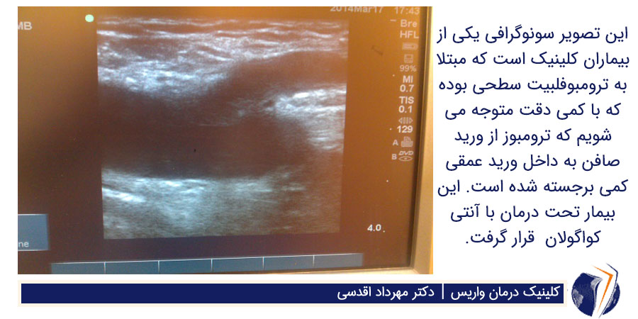 سونوگرافی ترومبوفلبیت سطحی