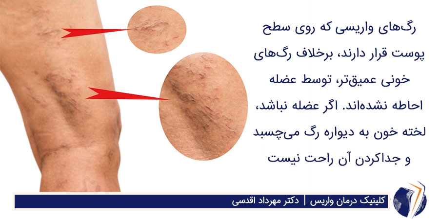 ترومبوفلبیت در رگ واریسی