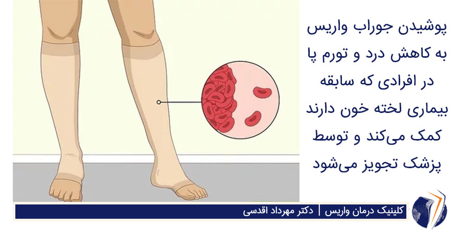 جوراب واریس برای برطرف کردن لخته خون در پا