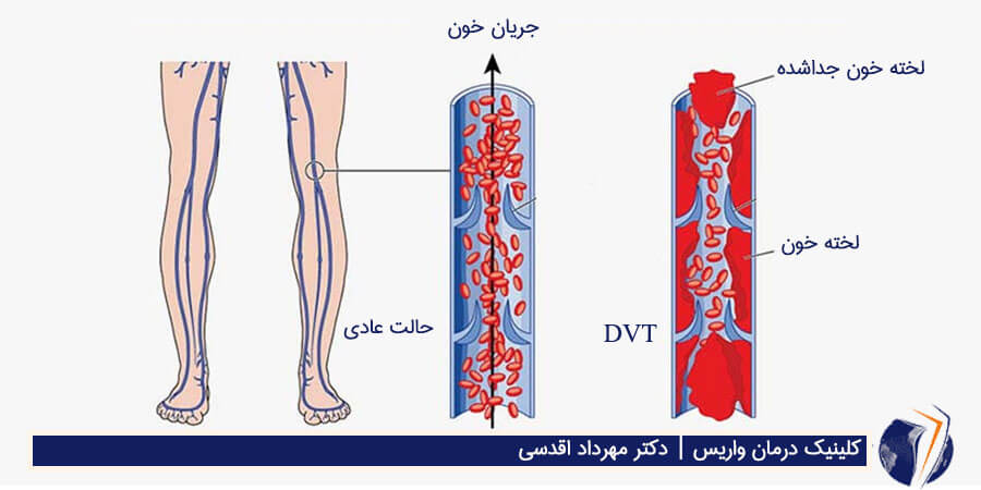 علل ایجاد dvt