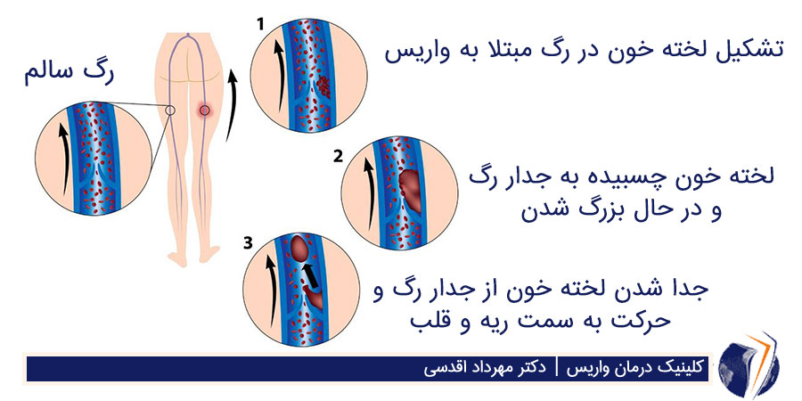 dvt چیست؟