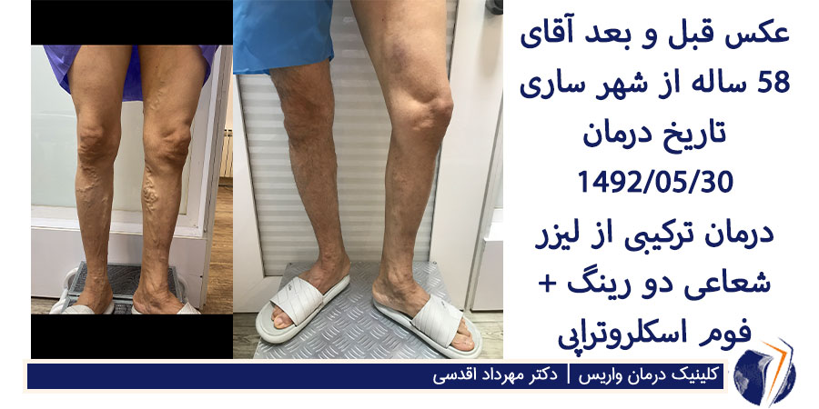 عکس قبل و بعد از درمان واریس برجسته طنابی پا آقای 58 ساله