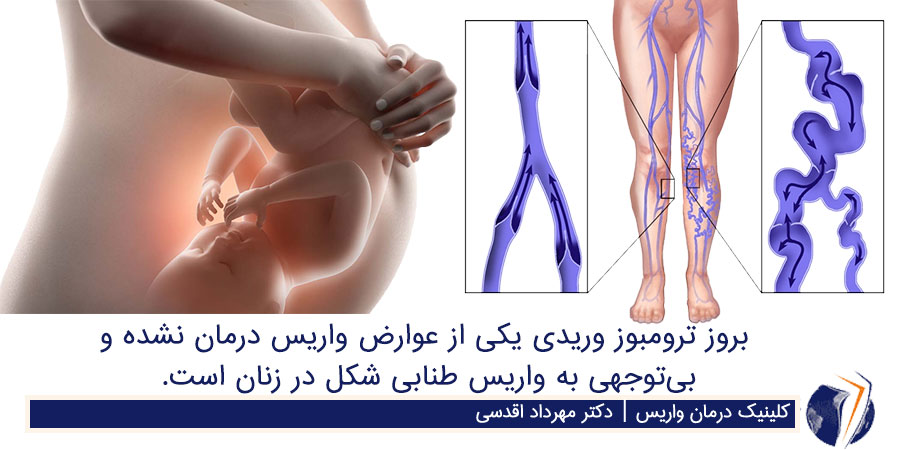 علائم لخته خون در بارداری