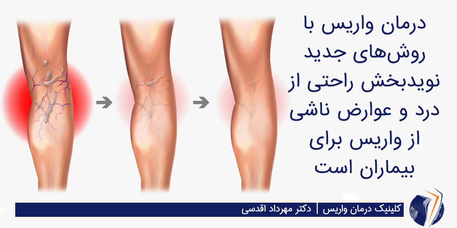 درمان واریس بدون جراحی