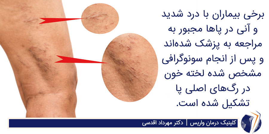 لخته خون در رگهای واریسی