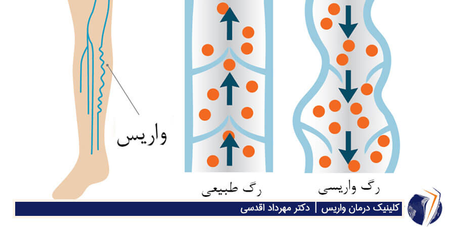 مقایسه رگ واریسی و رگ طبیعی در درمان واریس