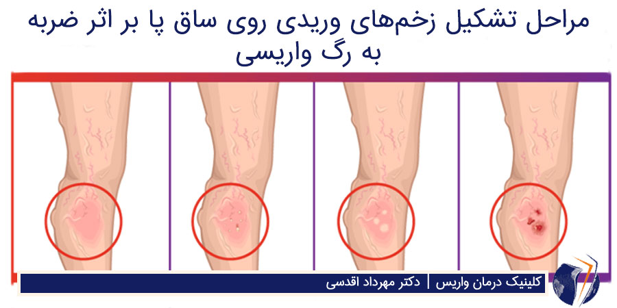 زخم واریس