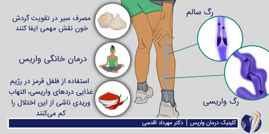 درمان خانگی واریس