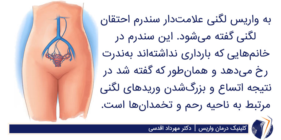 واریس لگن تخمدان و واژن