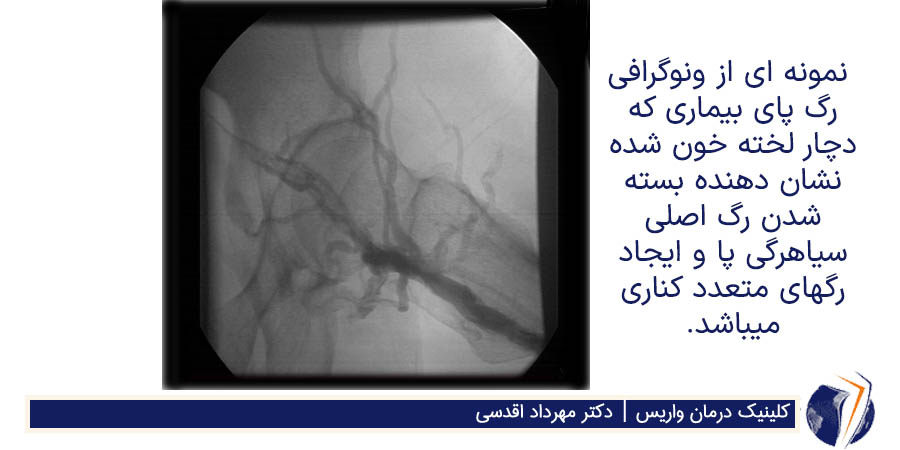 ونوگرافی رگ پای بیماری که دچار لخته خون شده