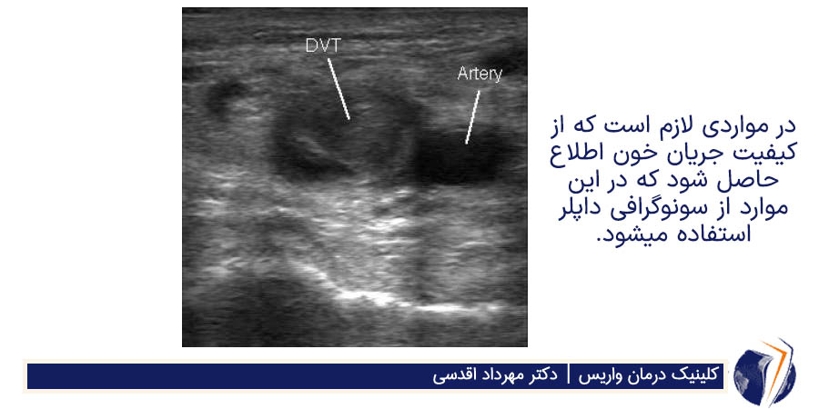 سونوگرافی داپلر