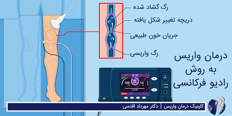 درمان واریس به روش رادیو فرکونسی