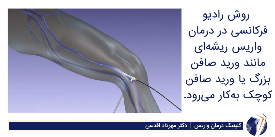 رادیوفرکونسی برای درمان واریس پا