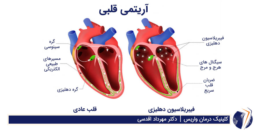 آریتمی قلبی