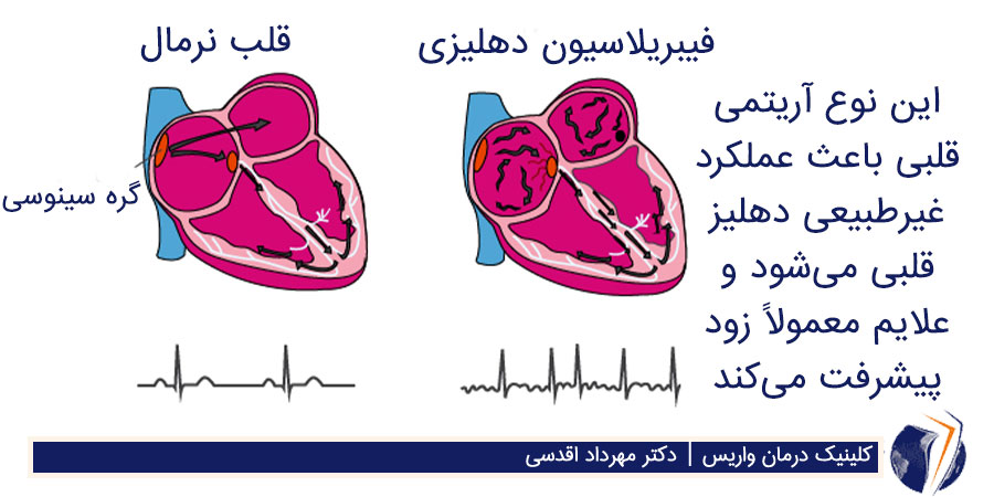 تشخیص آریتمی قلبی