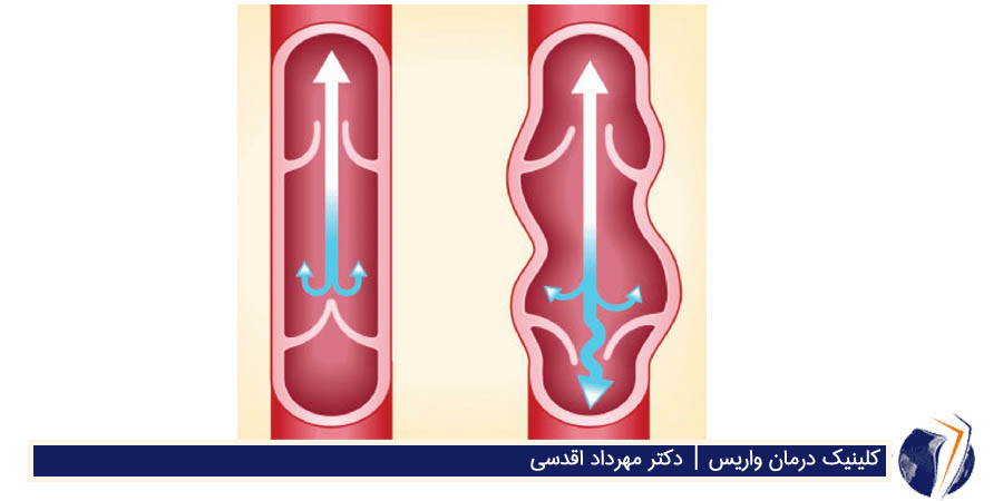 آسیب مویرگهای پاره شده