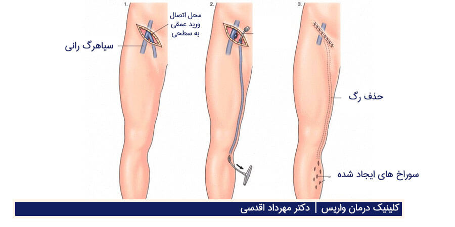 جراحی واریس و عمل واریس پا