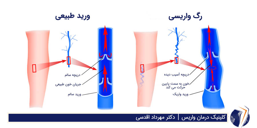 ورید طبیعی ، رگ واریسی