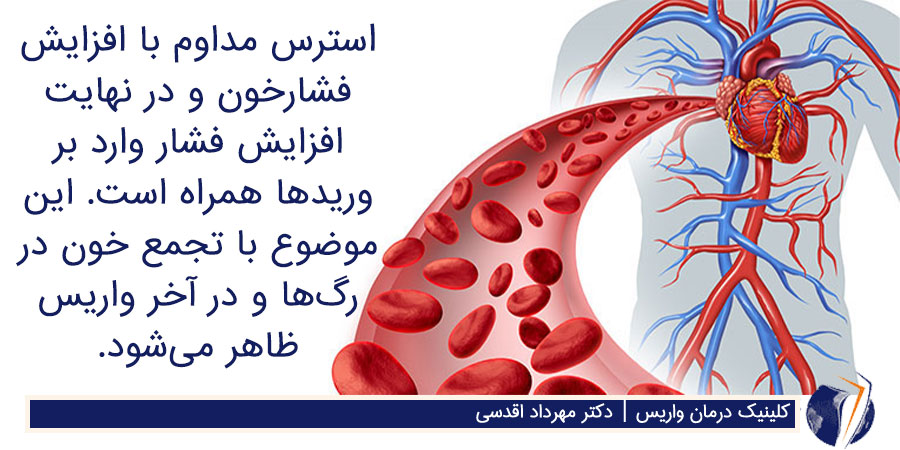 تاثیر استرس بر گردش خون و ابتلا به واریس