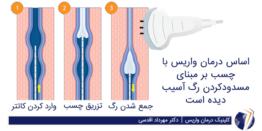 چسب واریس