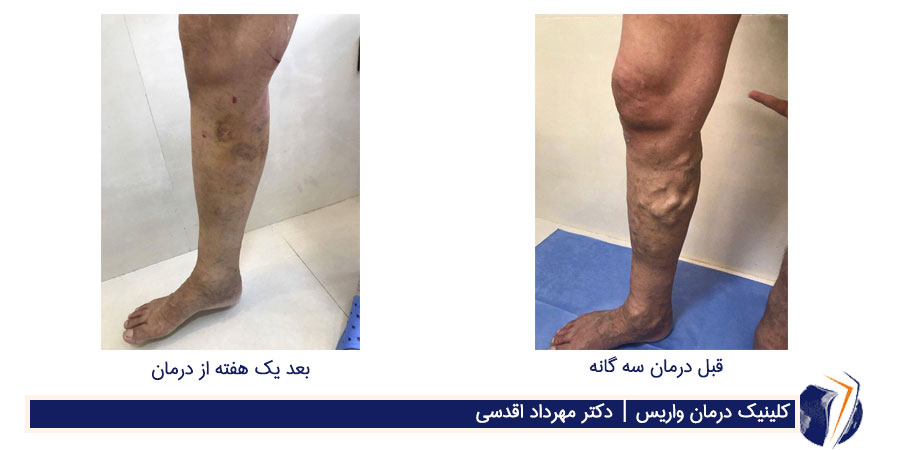 درمان تلفیقی واریس طنابی دریک جلسه برای مسافری از کردستان