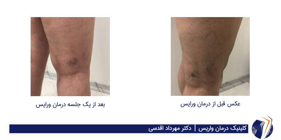 عکس واریس پا قبل و بعد از درمان