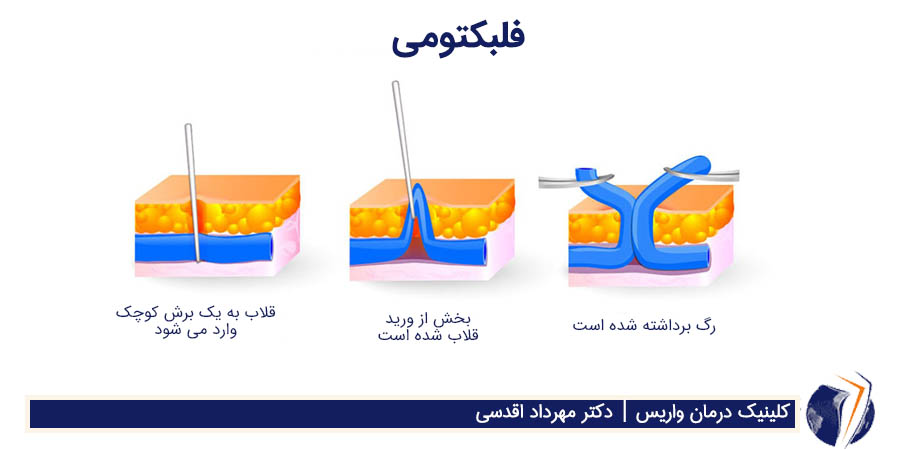 فلبکتومی