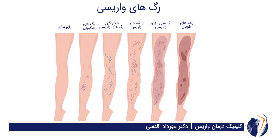 رگ های واریسی