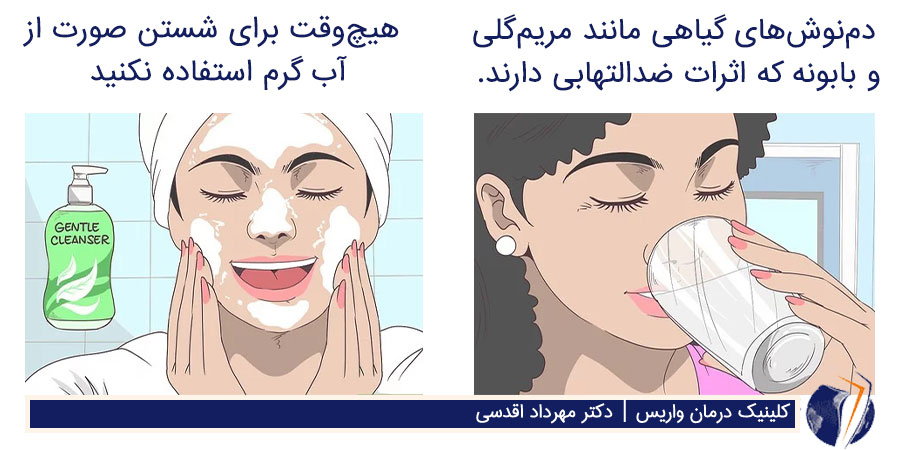 درمان خانگی واریس زیر چشم