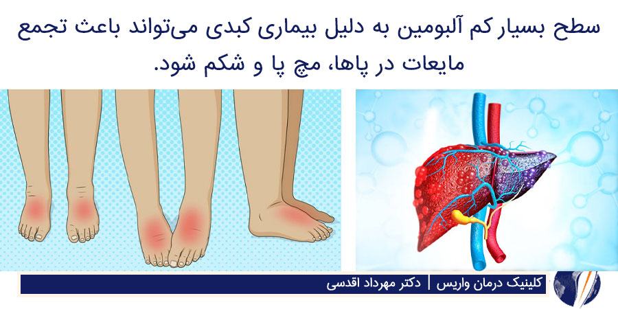 دلیل ورم مچ پا همراه با درد