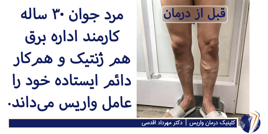 واریس برجسته ساق پا و ارثی در آقای جوان