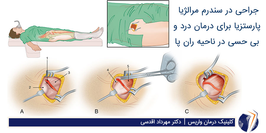 جراحی برای درمان بی حسی ران پا